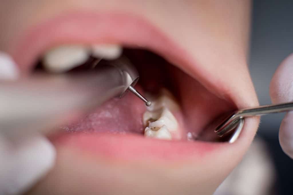 How Long Should a Tooth Hurt After a Filling